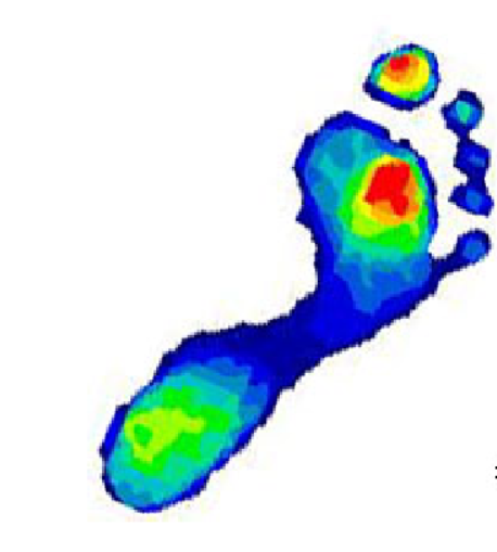 足底压力缓解与糖尿病足溃疡的防治 足底压力缓解与糖尿病足溃疡的防治