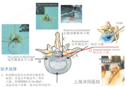 椎间孔镜路入的椎间盘突出横切面图解
